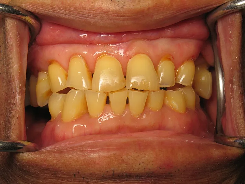 Before Porcelain Veneers treatment