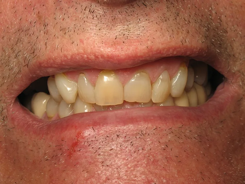 Before Dental Implants treatment