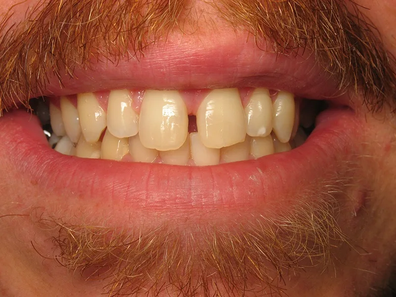 Before Full Restoration treatment